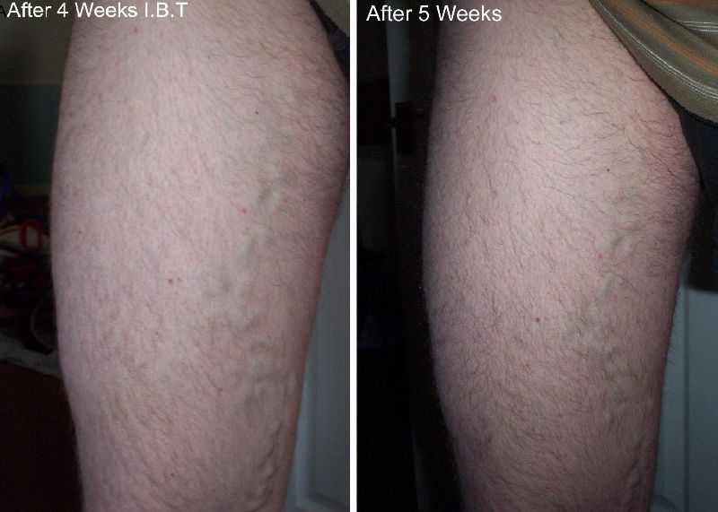 4 5 weeks Inclined Bed Therapy  varicose veins ibt 