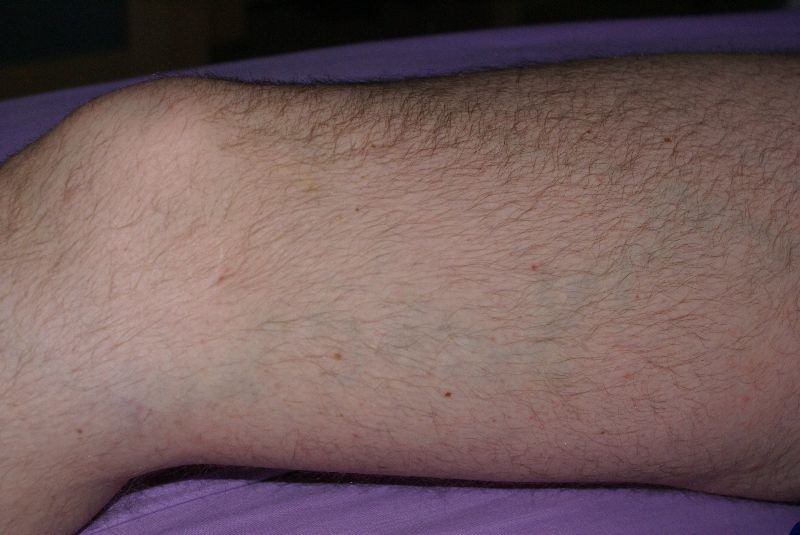 varicose veins shown while on Inclined Bed Morning IBT